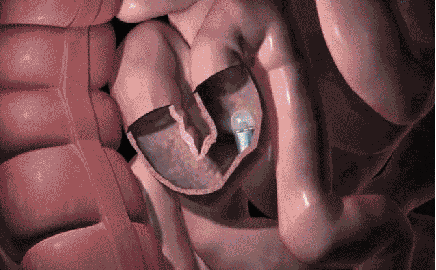 消化道检查新技术——结肠胶囊内窥镜