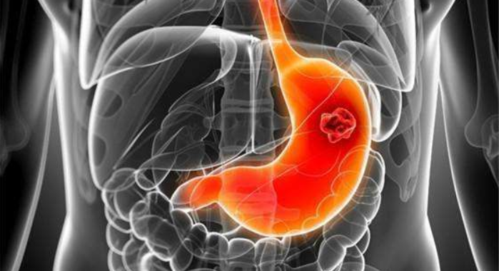 胃癌真的会遗传吗？真的！